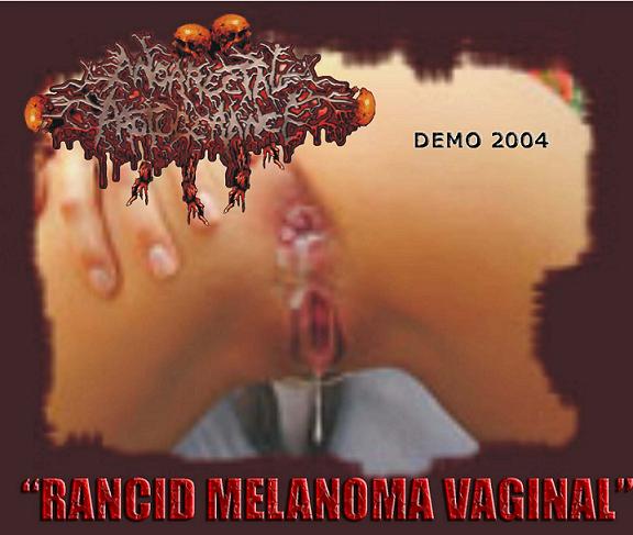 Rancid Melanoma Vaginal